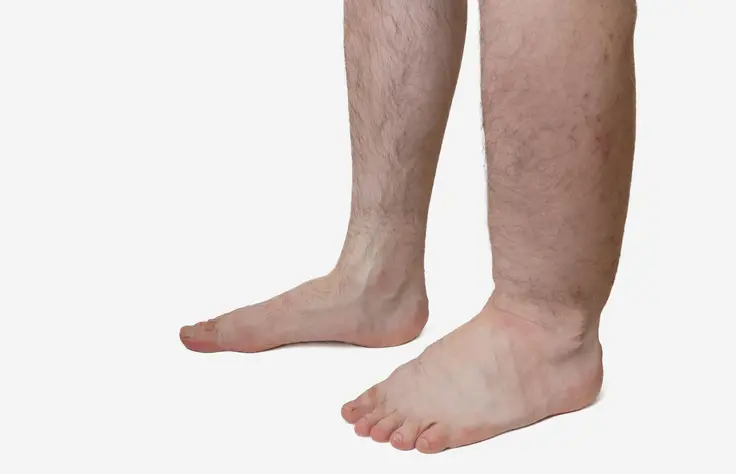 Oticanje nogu